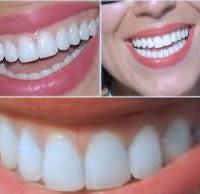 Dişleri Beyazlatma Yöntemleri